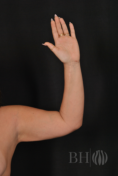 Abdominoplast With Lift Before & After